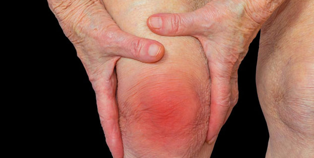 arthritis