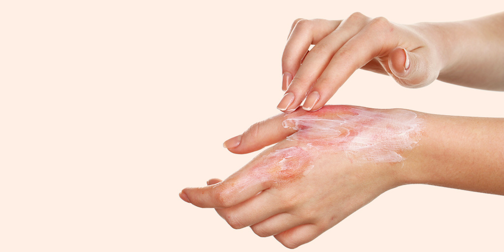 फर्स्ट, सेकंड, थर्ड डिग्री बर्न के उपचार