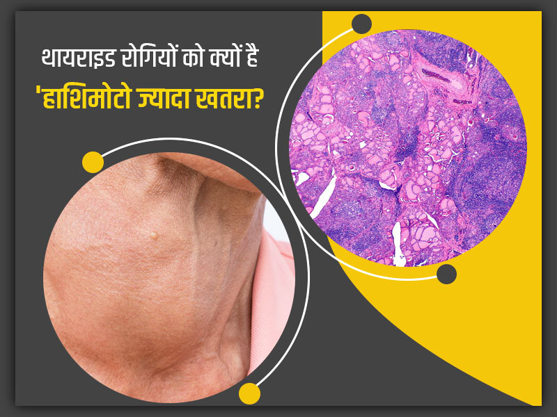 थायराइड रोगियों को क्यों रहता है 'हाशिमोटो' रोग का खतरा? जानें इस बीमारी का कारण, लक्षण और बचाव के उपाय