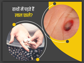 हाथ में खून से भरे लाल छाले (ब्लड ब्लिस्टर्स) क्यों होते हैं? जानें कारण और इसके लिए 7 घरेलू उपचार