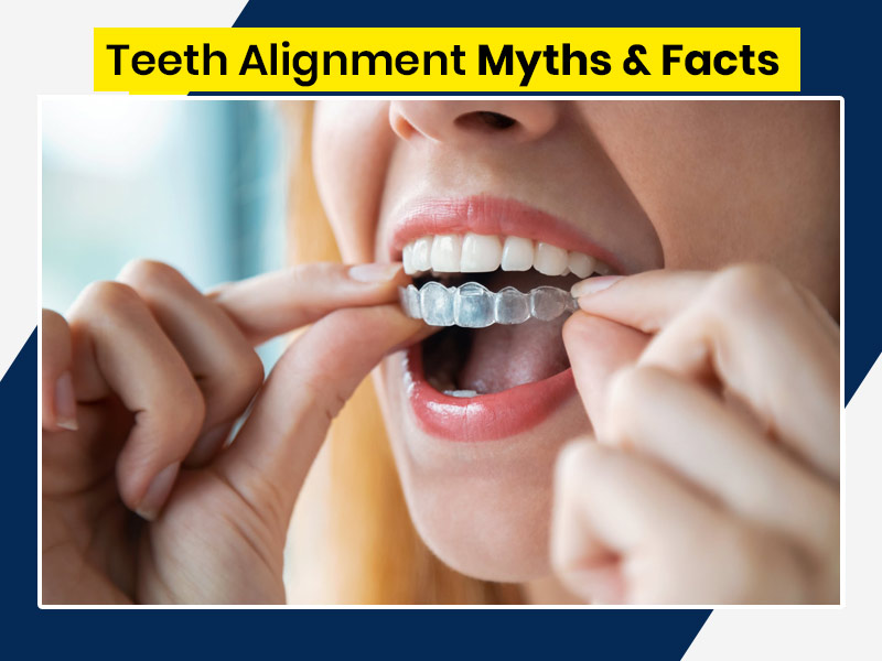 Planning to Get Teeth Aligners? Do Not Fall For These Myths, Read Facts