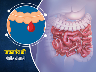 Gastrointestinal Bleeding: चेहरे पर पीलापन और कमजोरी हो सकते हैं पाचनतंत्र की इस गंभीर बीमारी के लक्षण