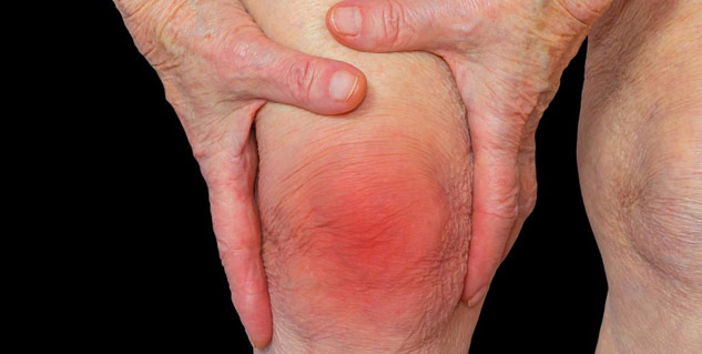 arthritis