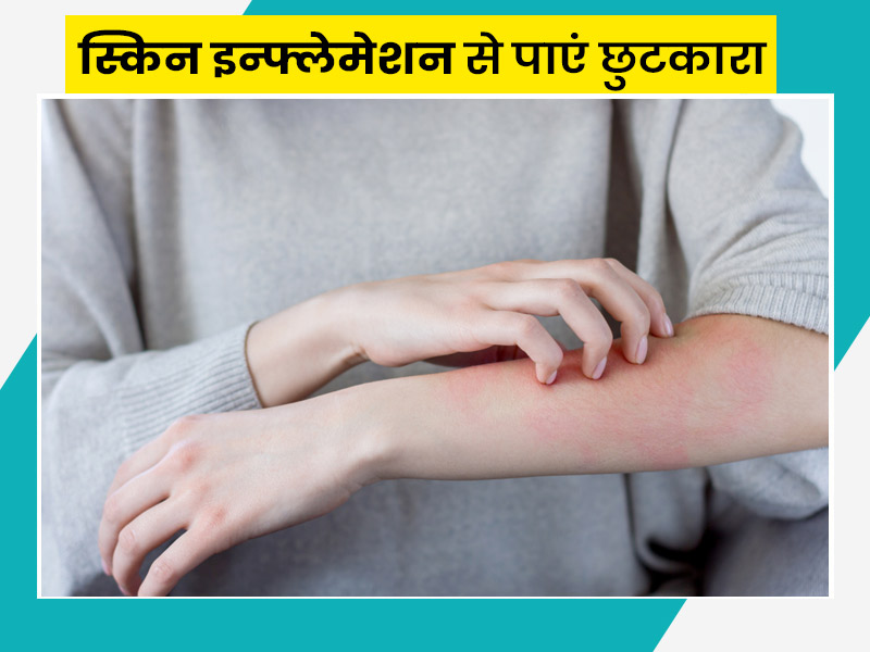 इन 5 घरेलू नुस्खों का सेवन आपको स्किन इन्फ्लेमेशन से दिलाएगा छुटकारा
