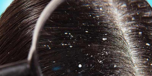 Inside1_Wetdandruff