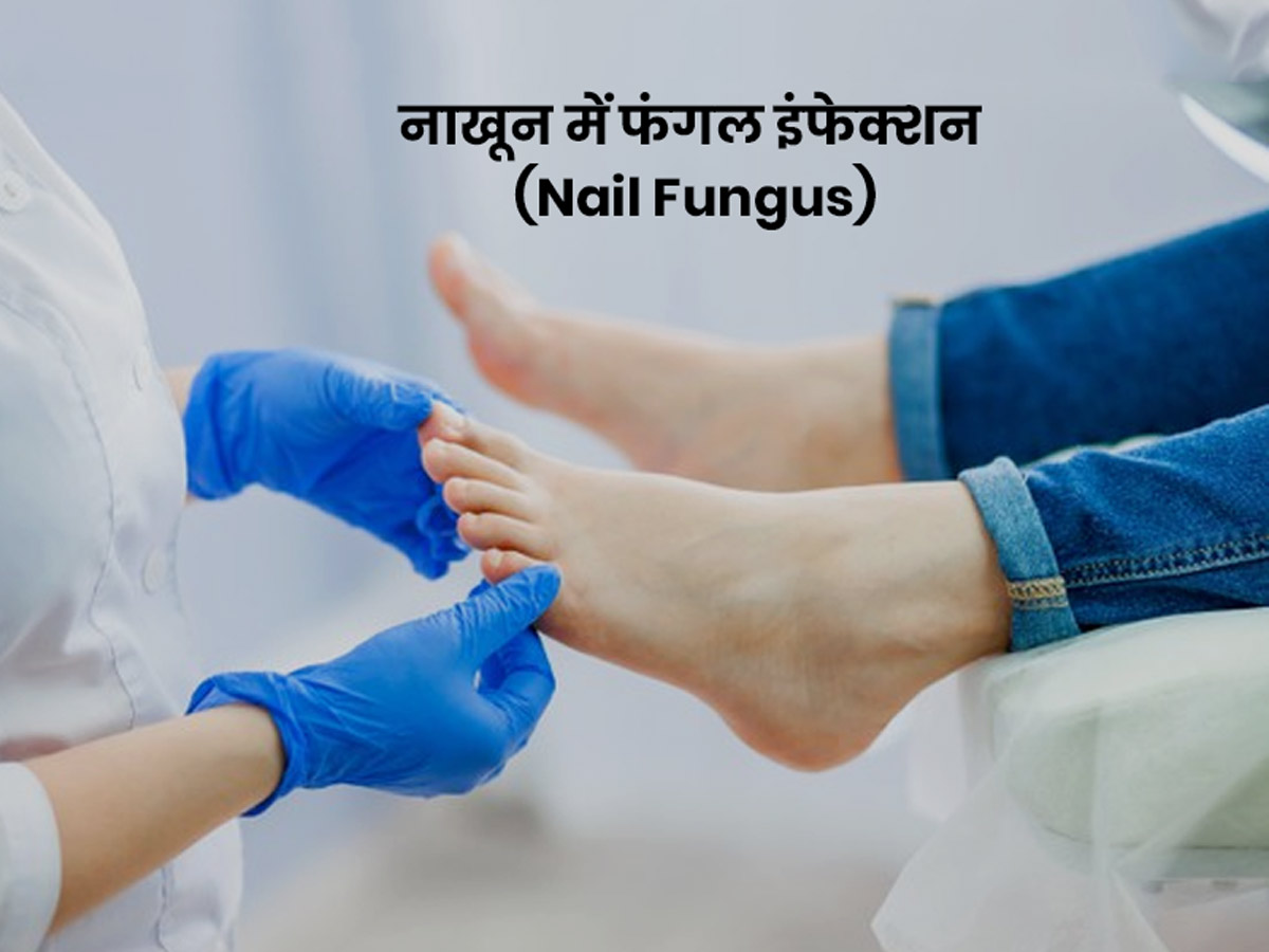 Nail Fungus Causes: Know About Symptoms And Treatment of Nakhun Mein Fungus  in Hindi। नाखून में फंगल इंफेक्शन होने के कारण, लक्षण और उपचार। onlymyhealth