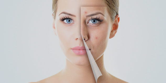 chemical peel