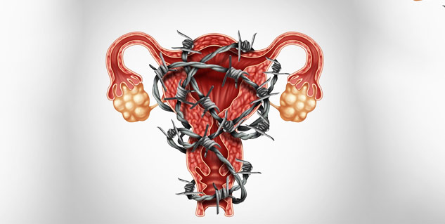 endometriosis
