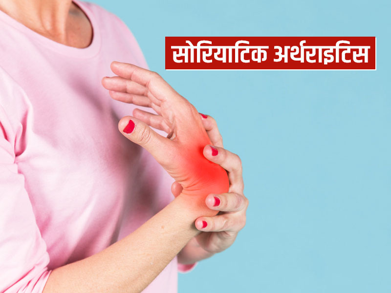 जानें सोरियाटिक अर्थराइटिस कैसे करता है शरीर को प्रभावित? साथ ही इस बीमारी के लक्षण और इलाज