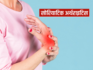 जानें सोरियाटिक अर्थराइटिस कैसे करता है शरीर को प्रभावित? साथ ही इस बीमारी के लक्षण और इलाज