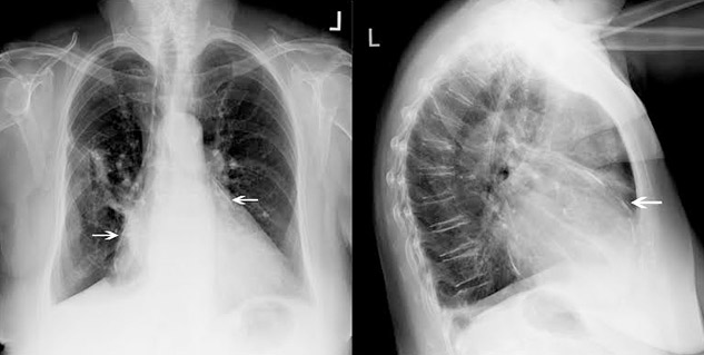 what-is-pericarditis-know-everything-about-this-heart-disease