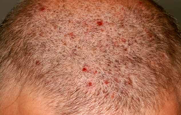 Head Sores Scalp Folliculitis