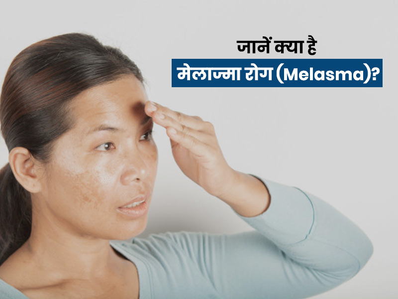 Melasma Diseases: चेहरे पर गहरे धब्बे हो सकते हैं 'मेलाज्मा' के लक्षण, जानें इसके 4 कारण और इलाज
