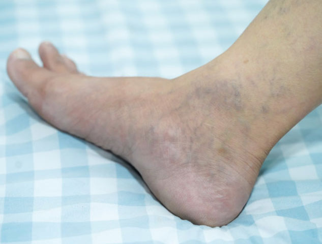 spider veins