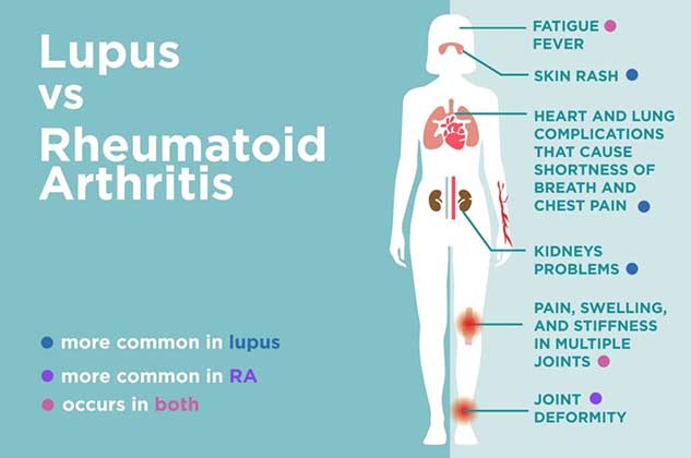 Rheumatoid Arthritis And Its Effects On Women. Know Symptoms & How ...