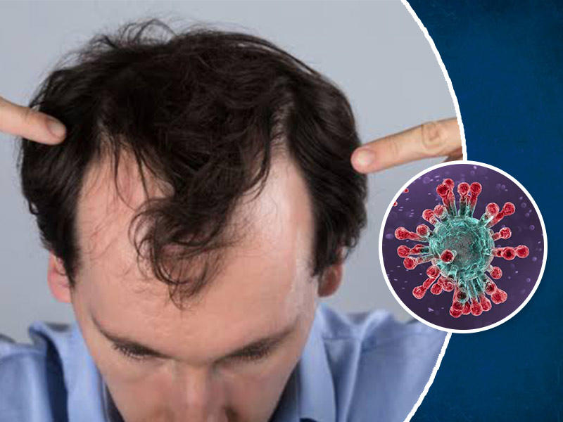 Hair Fall In Post Covid Syndrome? Here Are The Causes And Ways To ...