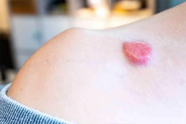 skin cancer symptoms