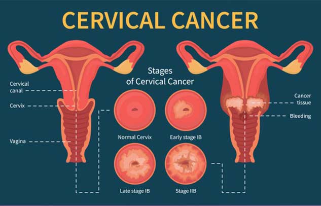 cervical cancer