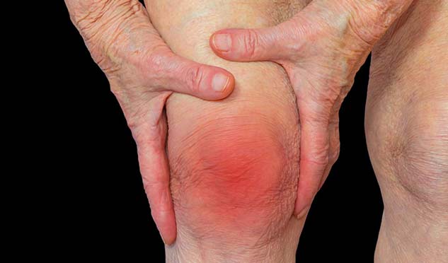 arthritis