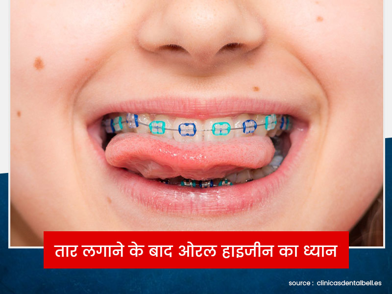 बच्चाें के दांताें में ब्रेसेस (तार) लगवाने के बाद ऐसे करें उनके मुंह की साफ-सफाई, ताकि दांत रहें सुरक्षित