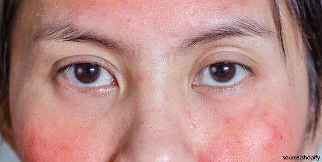 skin issues