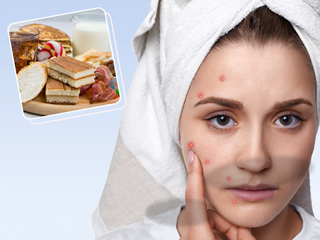 स्किन से जुड़ी परेशानियों में भूलकर भी न करें इन 6 तरह के फूड्स का सेवन, जानें इनसे होने वाले नुकसान