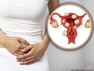 गर्भाशय में गांठ (रसौली) होने पर क्या खाएं और किन चीजाें से करें परहेज? जानें डाइट से जुड़ी जरूरी बातें