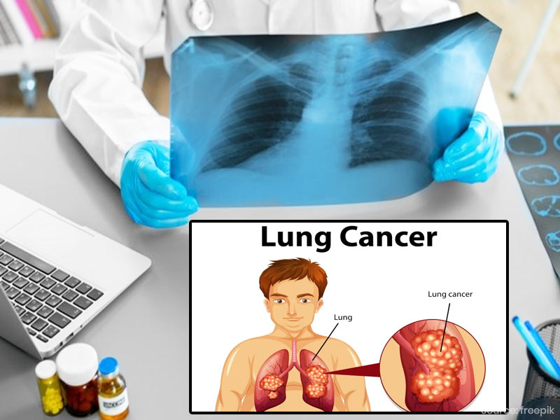 Diagnosing Lung Cancer at An Early Stage Can Save Lives, Know About 4 Methods of Testing Lung Cancer