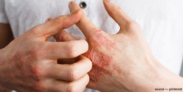 allergy