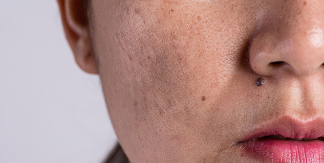 Inside1signsofpigmentation