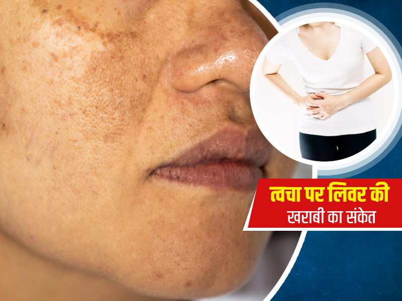 लिवर की बीमारी होने पर त्वचा पर दिख सकते हैं ये 5 संकेत, डॉक्टर से जानें बचाव के उपाय