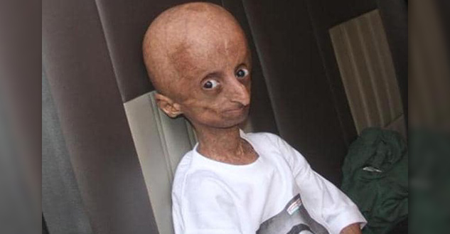 Progeria-Syndrome-Causes-Symptoms-Treatment