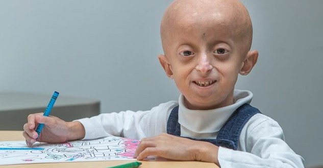 Progeria-Syndrome-Causes-Symptoms-Treatment