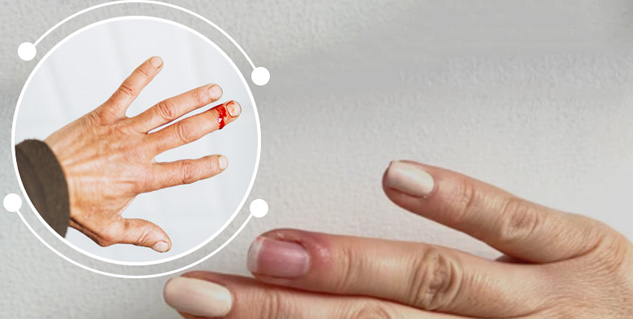 Jammed Finger: Symptoms, Diagnosis, Treatment, and More