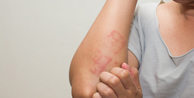 Inside2brinjalallergy