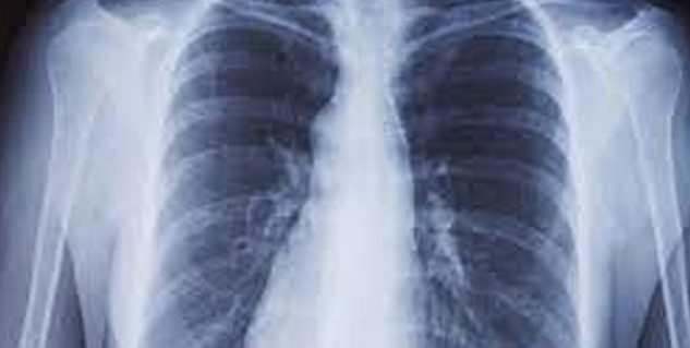 Inside3_chestinfection