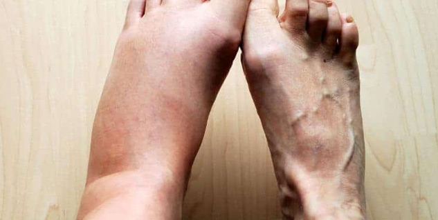 swelling in leg and pain