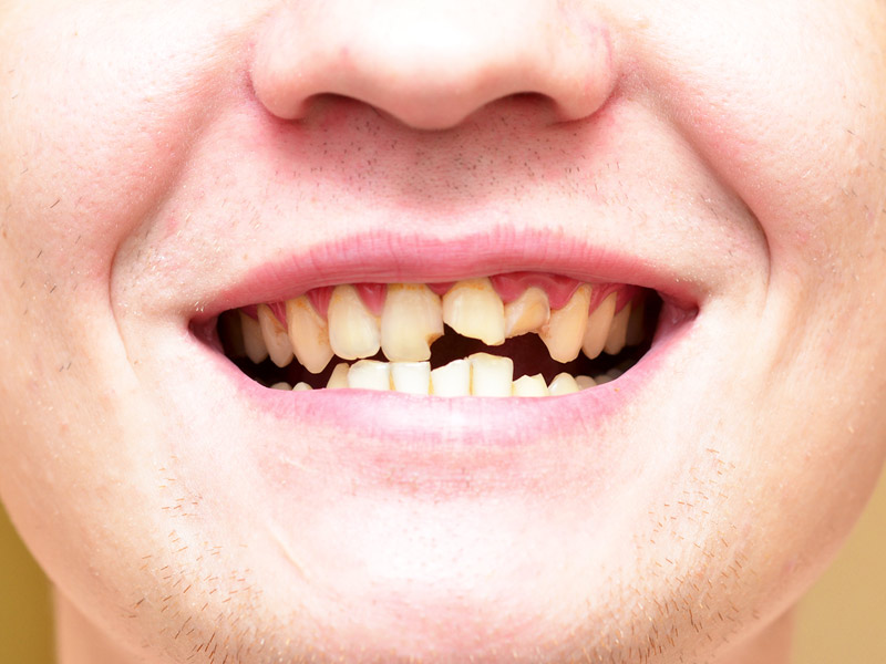 आधा टूटा दांत आपको दे सकता है कई गंभीर बीमारियां, डेंटिस्ट से जानें इसका कारण, खतरे और इलाज