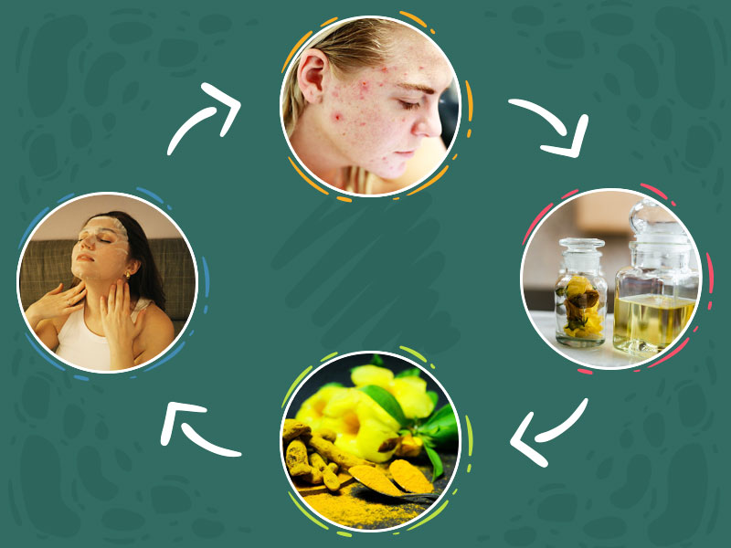 Having Cystic Acnes? Here Are 7 Home Remedies To Cure This Skin Problem