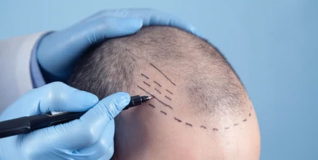 Hair Transplant