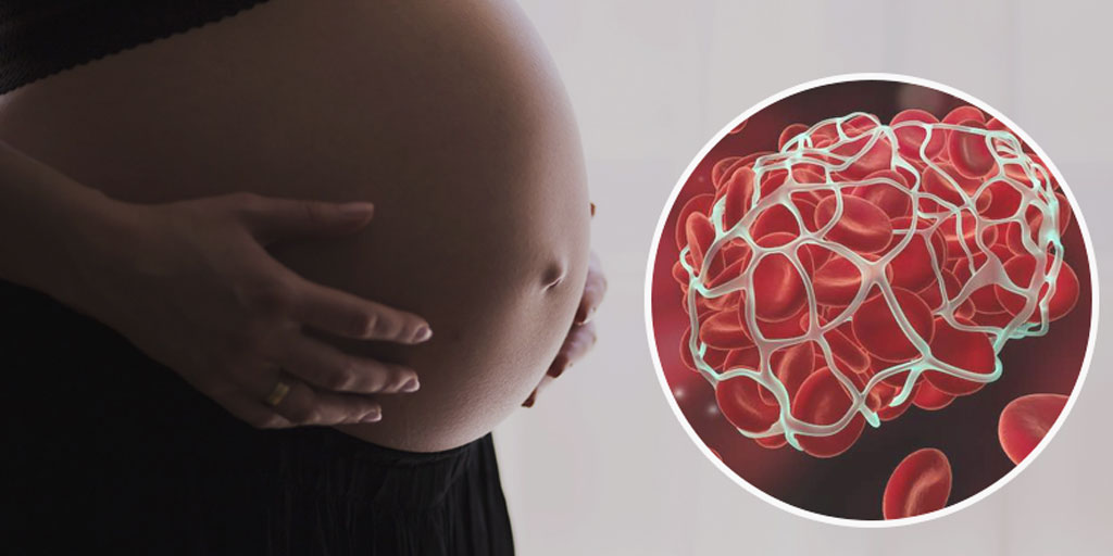 auses-and-symptoms-of-blood-clot-during-pregnancy-in-hindi