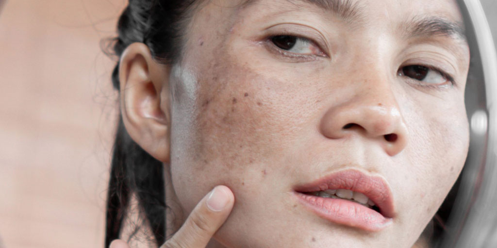 Skin Care Routine to Get Rid of Dark Spots in Hindi चेहरे के डॉर्क