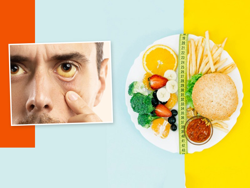 Jaundice Diet: Know What To Eat and What To Avoid From Nutritionist