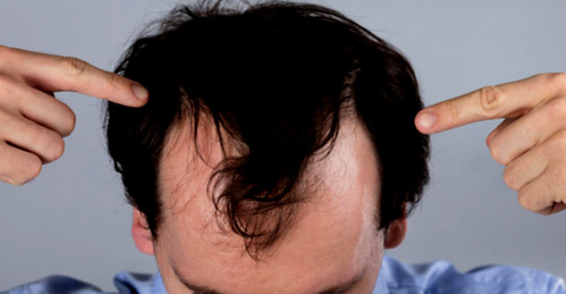 inside1baldness