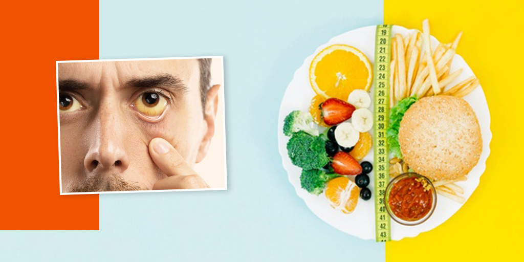 Jaundice Diet Know What To Eat and What To Avoid From Nutritionist