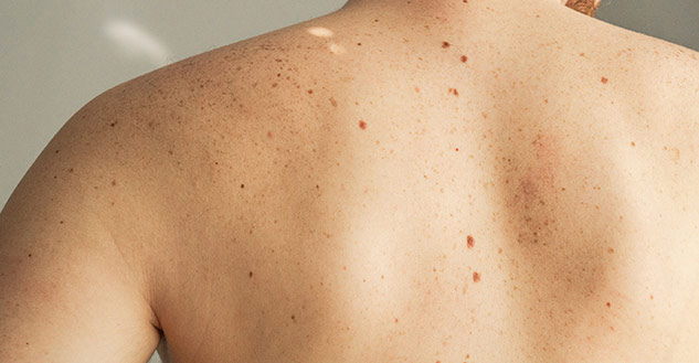 moles
