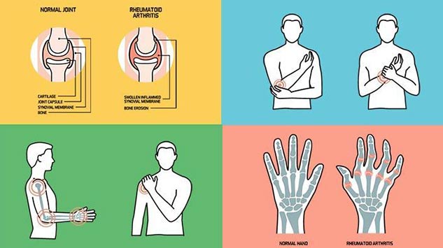 inside1RheumatoidArthritistips
