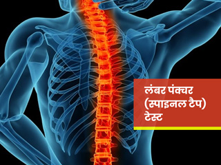 मिर्गी, सिर दर्द जैसी समस्याओं की जांच के लिए किया जाता है लंबर पंक्चर (स्पाइनल टैप) टेस्ट, जानें क्या है ये