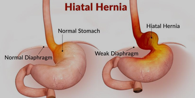 Heartburn/Hiatal Hernia Repair - Northern Light Health