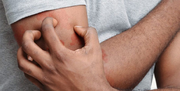 skin rashes aids symptoms
